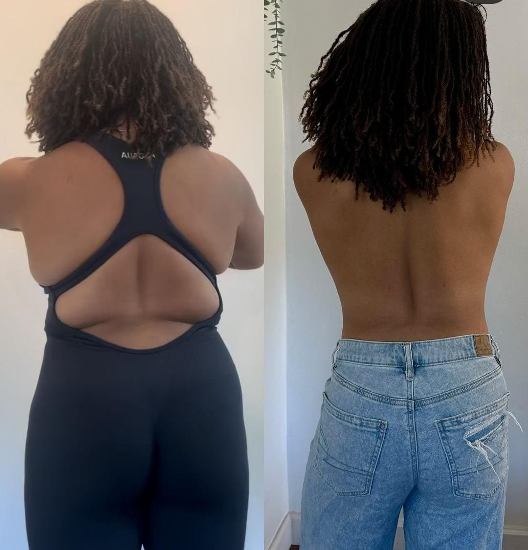 Before and after Goodbye Fat treatment